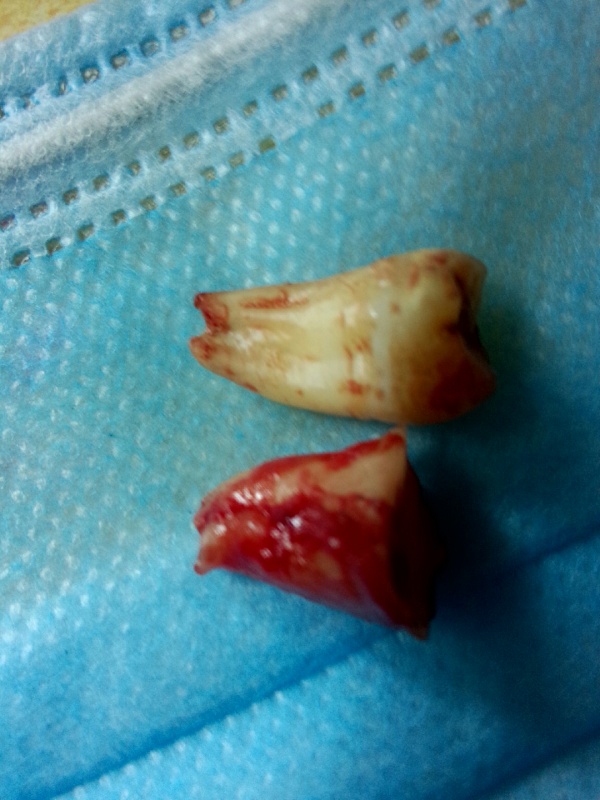 横生的智齿一定要拔除吗