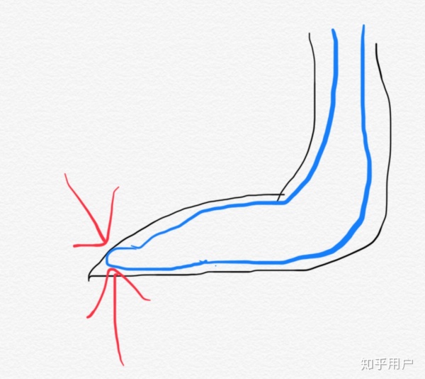 3:裤袜狭窄的脚尖部位空间不足,脚趾相互挤在一起的力.