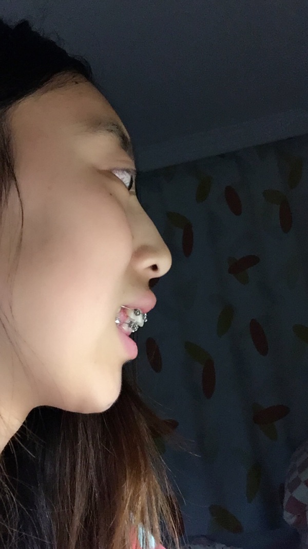 睡觉流口水 以前我还以为是我天生倒霉,后来医生告诉我是由于牙齿嘴